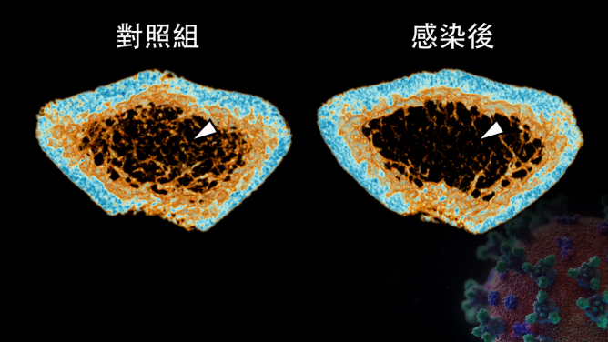 SARS-CoV-2 infection induces continuous inflammatory bone loss during both the acute and post-recovery phases of COVID-19. The 3D reconstructed micro-CT scans reveal that the bone trabecula (white arrow) density in the femur of SARS-CoV-2-infected hamsters (Right) is significantly lower than that of the Mock control (Left).