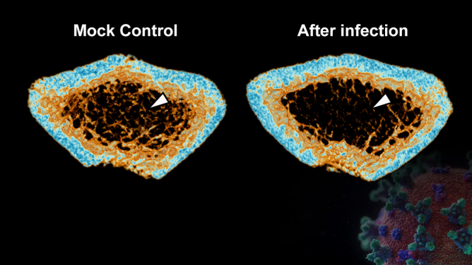 SARS-CoV-2 infection induces continuous inflammatory bone loss during both the acute and post-recovery phases of COVID-19. The 3D reconstructed micro-CT scans reveal that the bone trabecula (white arrow) density in the femur of SARS-CoV-2-infected hamsters (Right) is significantly lower than that of the Mock control (Left).